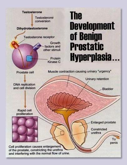 PROSTAT BÜYÜMESİ (BPH) sık idrara çıkma,