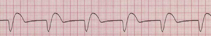 P dalgası: Yoktur QRS: