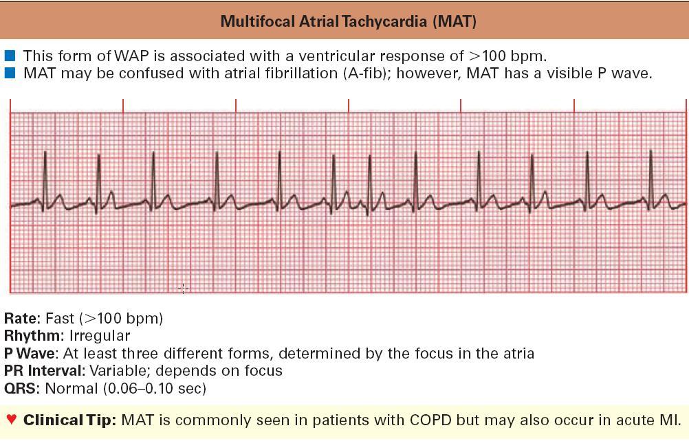 Wandering pacemaker ın hızının 100 den fazla olmasıdır.. MAT AF dönüşebilir.
