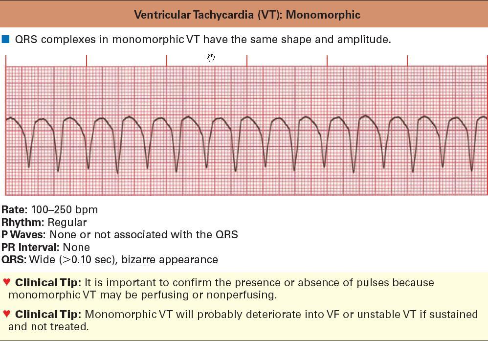 VT (monomorfik) Monomorfik VT: QRS şekli ve amplitüdü aynıdır Hız:.