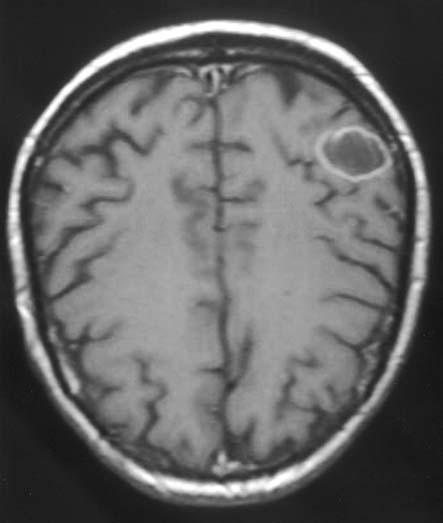 Vorikonazol ile tedavi edilen dirençli pulmoner ve serebral aspergilloz olgusu 4 Department of Pathology, Faculty of Medicine, Dokuz Eylul University, Izmir, Turkey, 5 Department of Radiology,