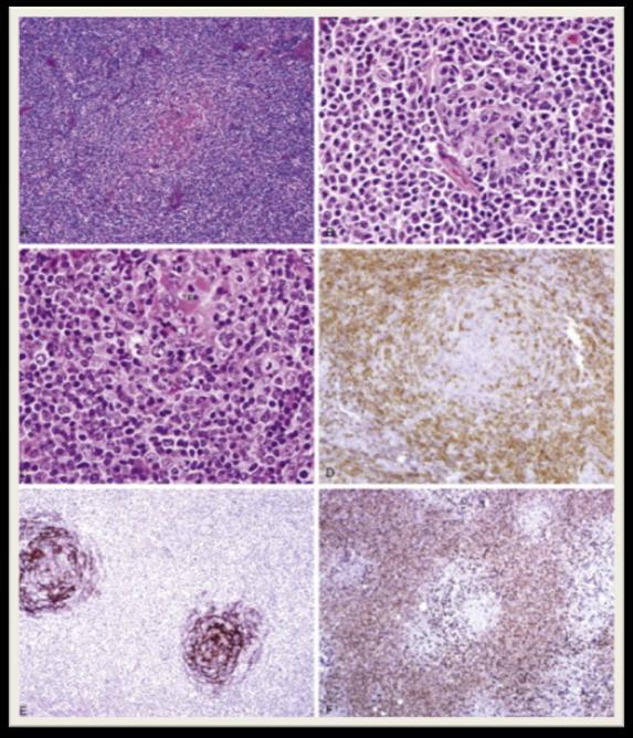Splenik tip- NMZL Jaffe ES, Harris NL, Vardiman