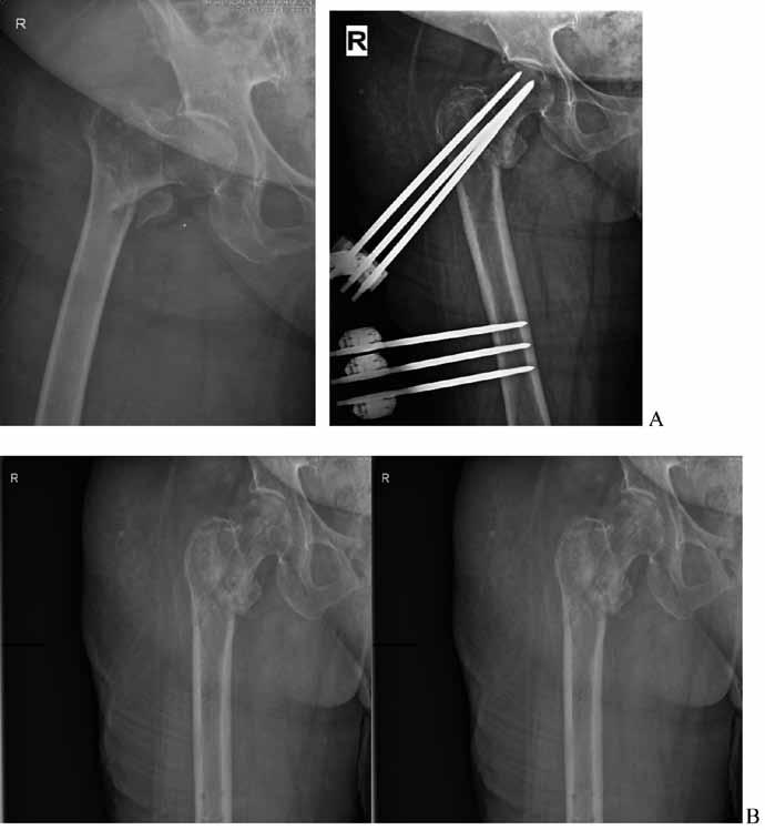 Geriatrik hastalardaki intertrokanterik femur kırıklarının eksternal fiksatörle tedavisi Şekil 2: 73 yaşında kadın hasta. Ameliyat öncesi, sonrası (A) ve ameliyat sonrası 14.