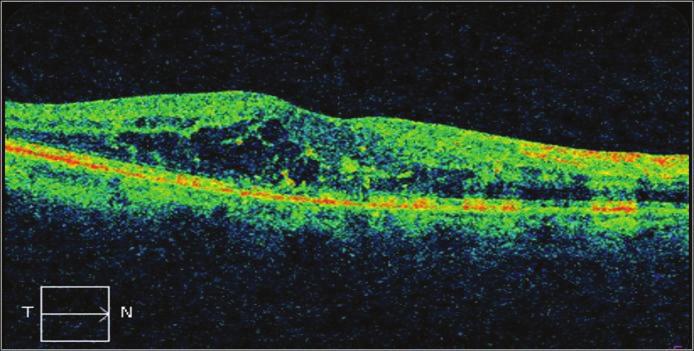 22 Optik Koherens Tomografi GİRİŞ Optik koherens tomografi (OKT), biyolojik dokulardan mikron çözünürlüğünde tomografik kesitlerin elde edildiği bir görüntüleme tekniğidir.