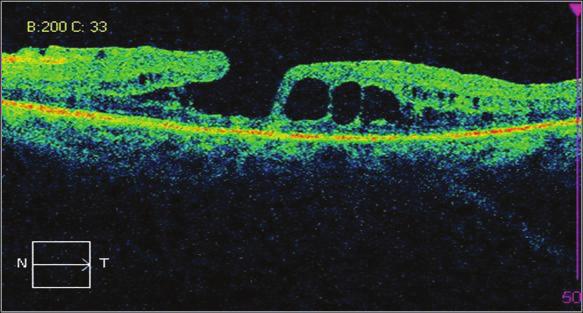 Kronik kistoid ödemde görülen diğer bir komplikasyon ise lameller veya tam kat maküla deliği oluşumudur (Resim 4). Seröz Maküla Dekolmanı: Maküler bölgede oluşan nörosensori retina dekolmanıdır.