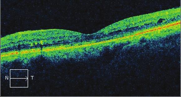 Optik Koherens Tomografi Hiperreflektif Noktalar: Diabetik maküla ödemli olgularda spektral OKT ile retinanın tüm katmanlarında yüksek yansıtıcılıklı noktalar gösterilmiştir.