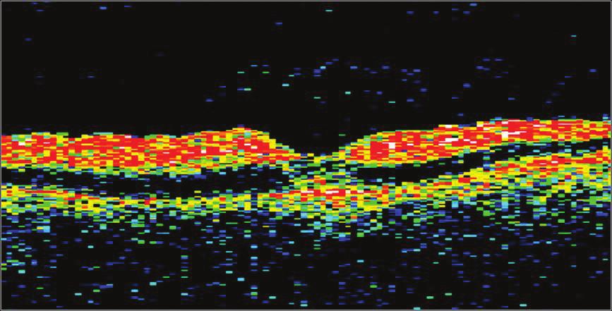 Görme Prognozunun Değerlendirilmesi Spektral OKT, niceliksel değerlendirmenin yanı sıra retina tabakalarının ayrıntılı olarak değerlendirilmesine de olanak sağlamaktadır.