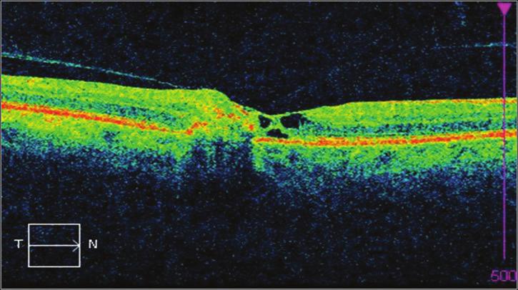 26 Optik Koherens Tomografi Resim 12: İJRT olgusunda makülada iç ve dış retinal kavitasyon, intraretinal pigment kümelenmesine bağlı artmış yansıtıcılık ve İLM draping.