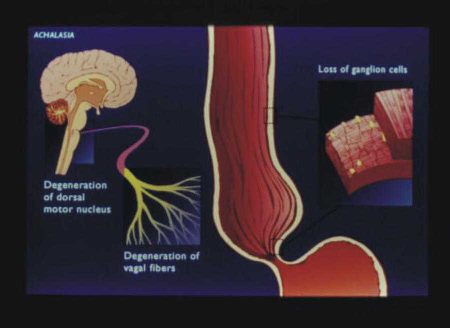 AKALAZYA Ganglion hücreleri kaybı Dorsal motor