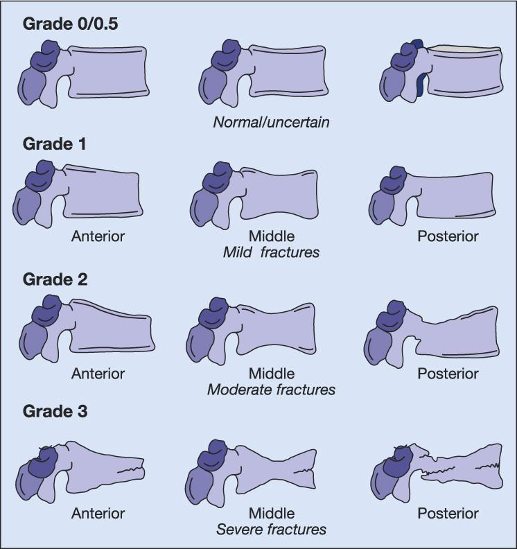 Semi-quantitative grading