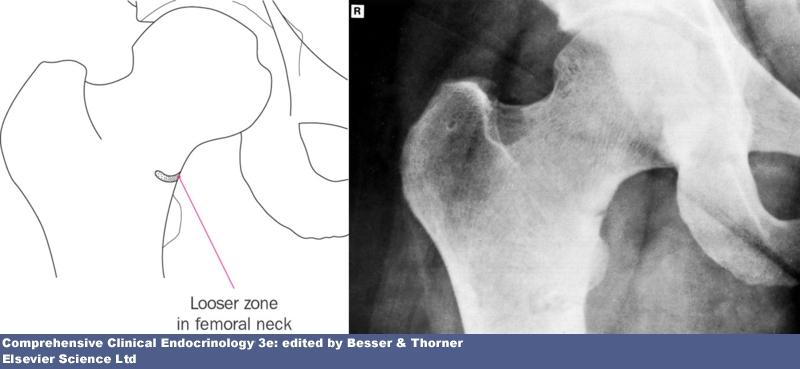 Osteomalacia: Looser's