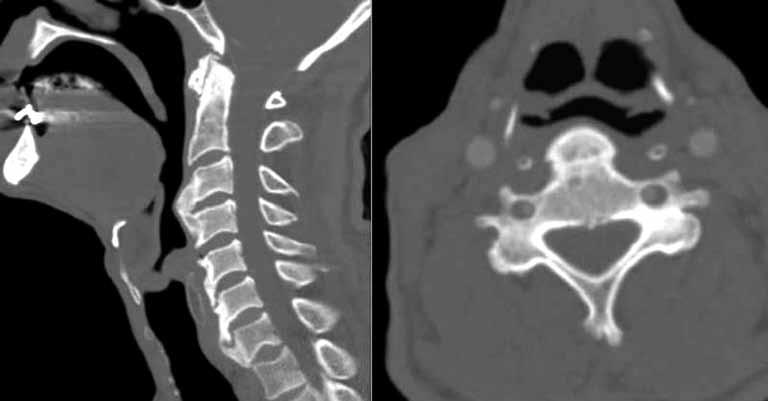Durgun Yetim ve ark. Nadir disfaji nedeni olarak servikal vertebral osteofit Şekil 2.