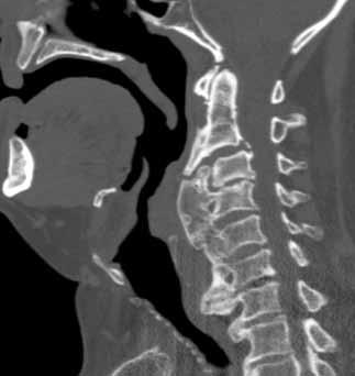 TARTIŞMA Difüz idiopatik iskelet hiperostozu vertebral kolonun nadir rastlanan bir tip florid hiperostozisidir.