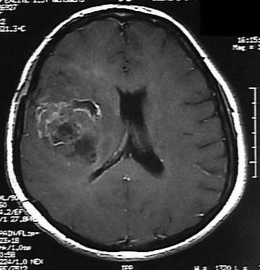 Tümör patolojisi yüksek evreli (Grade IV) gliom geldi. Hastaya Resim 3. Post-op üçüncü ayda yapılan kontrol MRG.