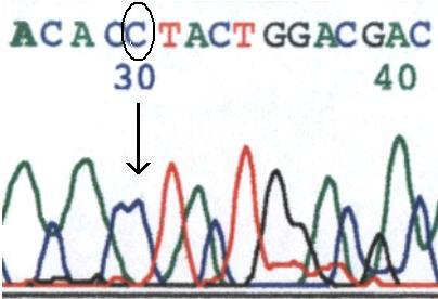 Fenilketonüri Tüm Gen Dizi Analizi (PAH Geni) Sinonim: PKU genetik analiz, Fenilalanin hidroksilaz gen defekti, PAH mutasyonları Sonuç Verme Zamanı: 1 hafta sonra Numune Miktarı: 5ml Referans