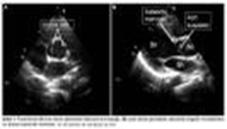 Eko-doppler ile dinamik gösterge araştırması yapay solunum uygulanan hastalarda tepe aort akım hızında ( Vpeak ) solunuma bağlı değişikliklerin incelenmesidir.