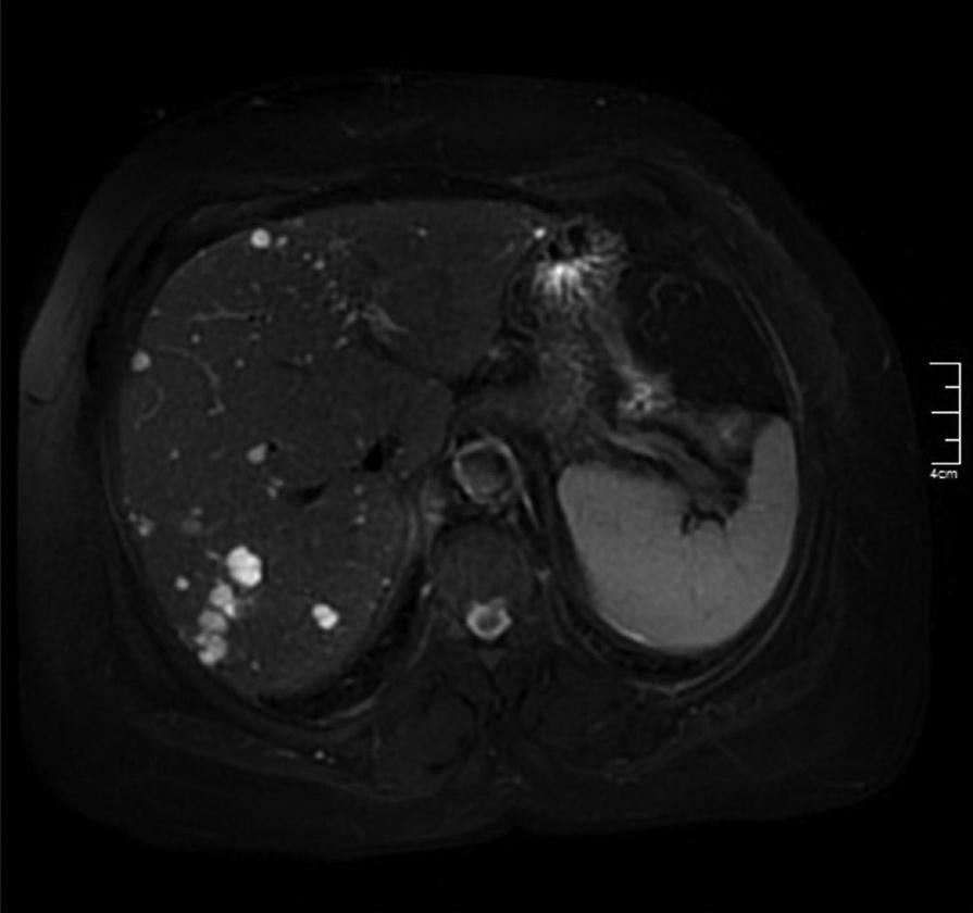 Toraks BT incelemesinde karaciğerde nodüler düzgün konturlu hipodens lezyonlar mevcut. Resim 2.