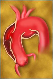 Aort lümeninden intima yırtığı adı verilen bir çıkış noktasından çıkan kanın, media