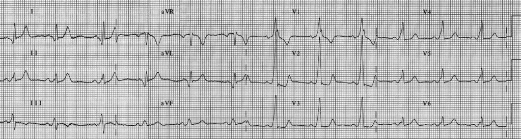 90 Türk Aritmi, Pacemaker ve Elektrofizyoloji Dergisi Olgu Sunumu Bilinen Wolf Parkinson White sendromu tanısı olan 24 yaşında bayan hasta, medikal tedaviye dirençli tekrarlayan semptomatik