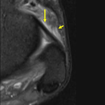 Ayak Bileği: Bağ ve Tendonlar 493 A B C Resim 2. A-D. Normal anterior talofibuler bağ (ATFB) ve bağ yaralanmaları. (A) Normal bağ lineer, 2mm kalınlıkta ve sinyalsiz izleniyor (oklar).