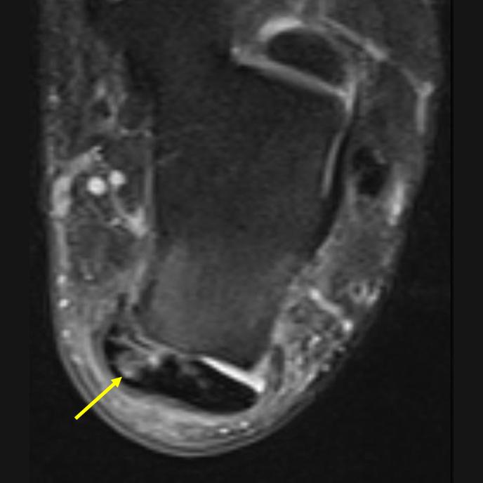 498 Çevikol C. A Resim 8. A, B. İnsersiyöz aşil tendiniti, tendonda kısmi yırtık (oklar) ve retrokalkaneal bursit (yıldız). (A) Aksiyal ve (B) Koronal yağ baskılı PD kesitler.