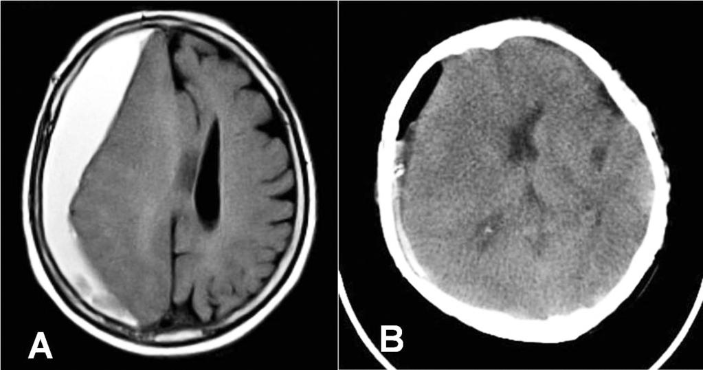 Kronik Subdural Hematom Olgularımızın Cerrahi Sonuçları tomografi ile konulur (4).