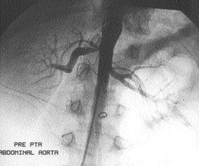 A B C D Resim 2. Olgu no 5. A. Abdominal aortografide erken bifurkasyon gösteren anterior-posterior renal arter divizyonlar ç k mlar nda yaklafl k %65 stenoz izlenmektedir. B. Balon anjiyoplasti sonras stenozun büyük oranda geriledi i görülmektedir.