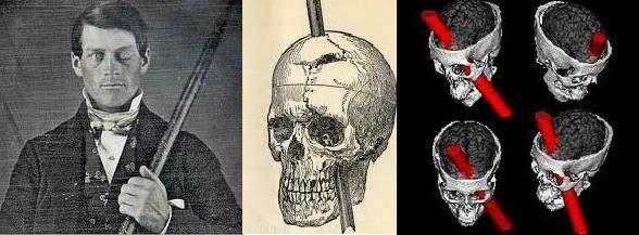 Manik epizod-kognitif işlevler Phineas gage-ventral prefrontal korteks lezyonu İmpulsivite