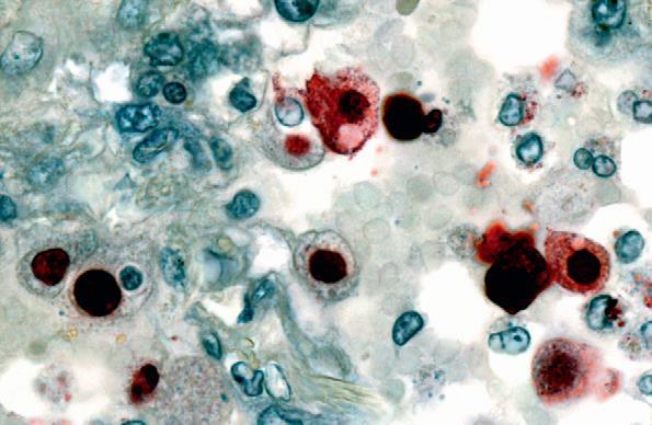 Patogenez 2009 pandemik influenza H1N1 viral antijeni, alveolü döşeyen hücrelerin nükleusunda kırmızı boyanmış olarak