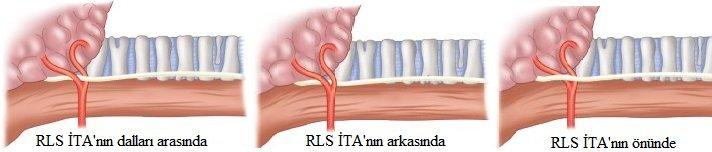 Cernea ve arkadaşları nın tariflerine göre SLS in external dalı STA ile olan ilişkisinde, Tip I de sinir arteri tiroid polünün üst kenarının 1 cm üstünden çaprazlar.
