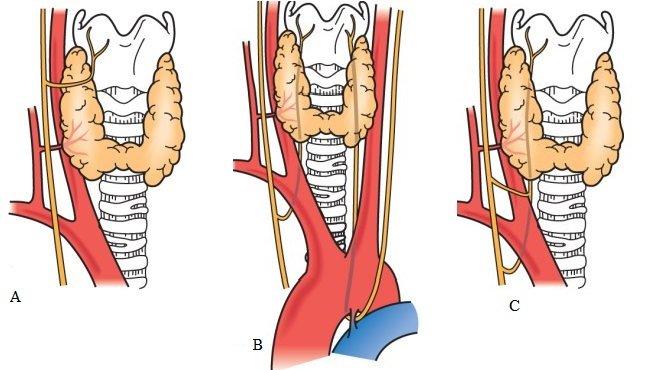 Çok ender olarak rekürren laringeal sinir servikal bölgede vagustan ayrılır ve non-rekürren laringeal sinir adını alır. Bu anomali sağda %0.6, solda%0.04 oranında görülür.