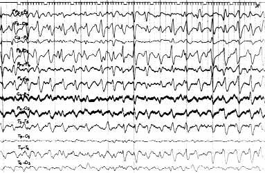 36 Epilepsi Cilt 12, Say 1, 2006 fiek L 5 Altm fl yedi yafl nda kad n hasta; multipl metabolik etken, diffüz yavafl aktivite ve trifazik dalgalar. fibromatosis tan lar na var ld.