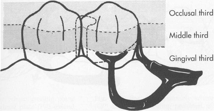 Bar kroşe genellikle daha az tanımlayıcı olan Roach kroşe kolu teriminin yerine kullanılır. Bu tip kroşeler protezin metal kaidesinden çıkar ve andırkat bölgesine gingivalden yaklaşır.
