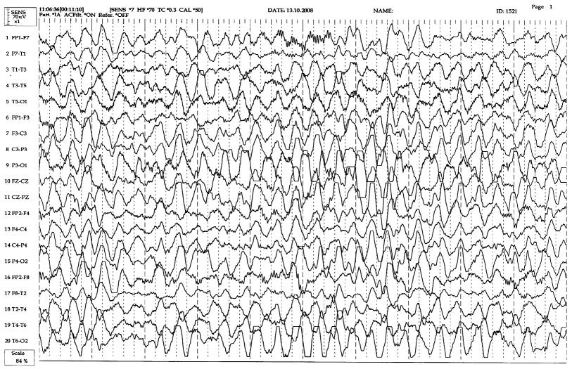 Lafora Hastalığı Biçer Gömceli Y, Erdal A, Kutlu G, İnan LE. Resim 6. Olgu 2 ye ait kontrol EEG trasesi; klinik düzelmeye ra men EEG bulgular n n devam etti i izleniyor.