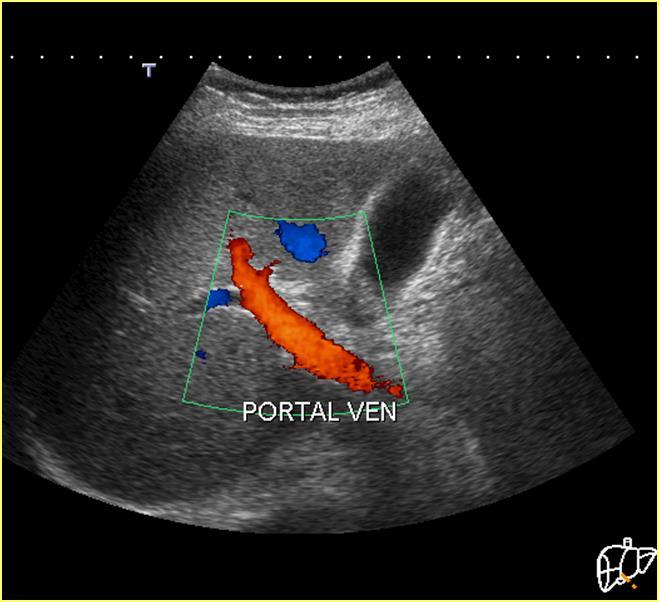 Portal Ven Karaciğer beslenmesinin %75-80 inden sorumlu SMV-IMV ve SV in birleşmesi sonrasında ana portal ven Portal hilus sonrasında