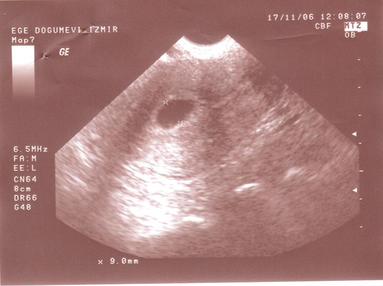 . fienyuva ve ark., nfertil hastalarda uterin faktörün de erlndirilmesinde transvaginal salin infüzyon sonografi Resim 3. TV-S S de normal uterin kavite görünümü. Resim 6.