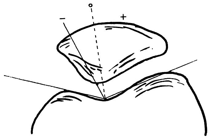 Sulkus açısı, troklear oluğun medial ve lateral duvarları tarafından oluşturulan açıdır. Ortalama 138 dir ve 150 den fazla olması anormaldir (Şekil 3.8).