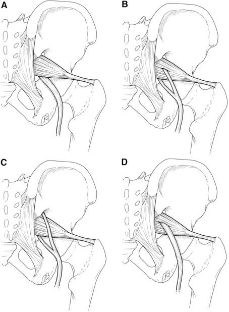 BÖLÜM 3: ALT EKSTREMİTE Şekil 3.28: Piriformis kası ve siyatik sinirin çeşitli ilişkileri Beaton ve Anson tarafından açıklandığı gibi. (A) En yaygını bölünmemiş sinir piriformis kasının (% 84.