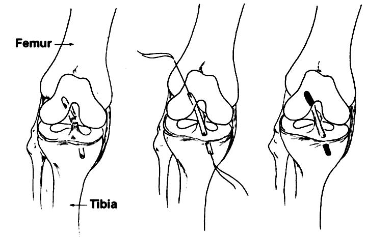BÖLÜM 3: ALT EKSTREMİTE Cerrahi sırasında Patellar tendon greft kullanılacaksa doktor diz kapağı altından 2.5-7.5cm insizyon açar. Daha sonra artroskop kullanarak yırtık ÖÇB ı alır (Şekil 3.69).
