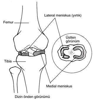 BÖLÜM 3: ALT EKSTREMİTE MENİSKÜS YIRTIĞI Dizin iç ve dış kısmında yer alan kartilaj dokular olan menisküsler tibianın üst kısmına yapışırlar ve femur ile temasları vardır.