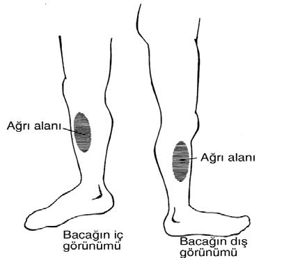 BÖLÜM 3: ALT EKSTREMİTE SHİN SPLİNT Dizin altında ve ön tarafta ayak bileğinin üzerinde ağrı (Şekil 3.151). Şekil 3.151: Stin splint alanı Mekanizması Genellikle aşırı kullanmaya bağlı meydana gelir.