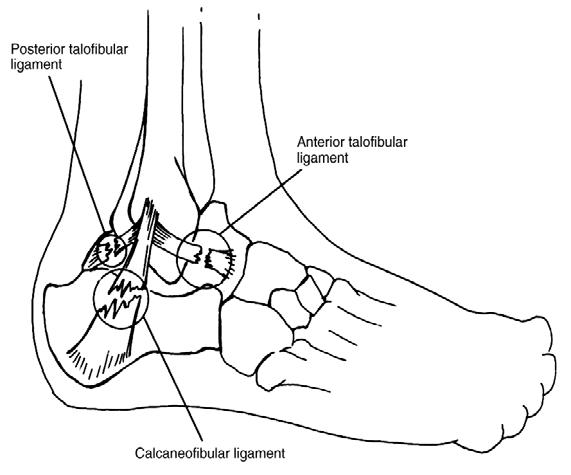 BÖLÜM 3: ALT EKSTREMİTE Bazen sprainler bağ hasarının miktarına bağlı olarak hafif ve ciddi olarak sınıflandırılır. Sprainlerin çoğu ayak bileğinin dış kısmında olur.