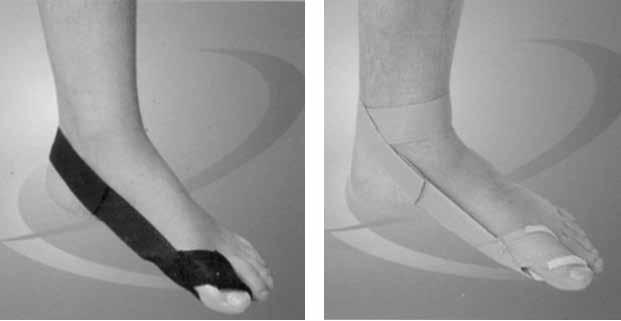 BÖLÜM 3: ALT EKSTREMİTE Semptomlar Başparmak tabanında kemik çıkıntısı Kızarıklık, şişlik ve baş parmak ekleminde ağrı Baş parmak tabanındaki deride kalınlaşma Teşhis Doktor ayağı inceleyerek X-ray
