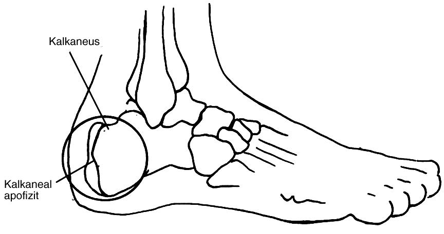 BÖLÜM 3: ALT EKSTREMİTE KALKANEAL APOFİZİT (SEVER S DISEASE) Çocuklarda kalkaneus üzerinde bir alanda kemiğin büyüdüğü yere apofiz denir.