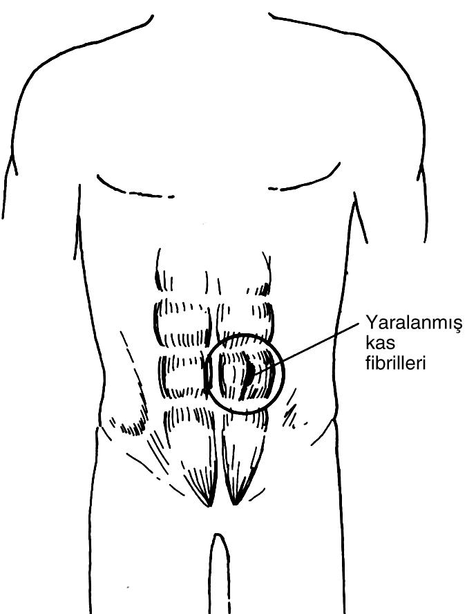 (Şekil Mekanizması Kaldırma ya da öksürme gibi zorlu aktiviteler esnasında bu kaslar straine uğrayabilir. Semptomlar Teşhis Abdominal kaslar üzerinde ağrı vardır.