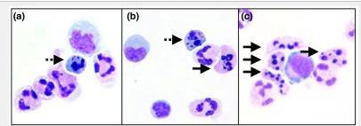 a) Apoptotik lenfosit b) Apoptotik lenfosit(kesikli oklar) ve apoptotik nötrofil c) Dört apoptotik nötrofil.