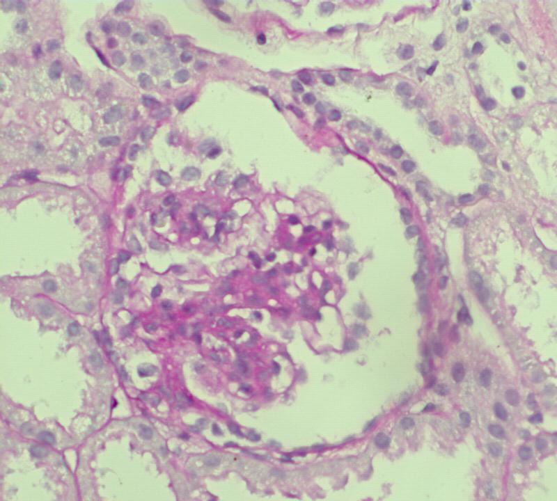 Mezangial matriks artışı: Mezangiumda ekstraselüler materyal birikiminin