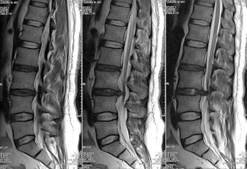 284 Acta Orthop Traumatol Turc (a) (c) (d) Şekil 1. 46 yaşında erkek hasta, sağ bacağa yayılan şiddetli bel ağrısı yakınması ile başvurdu. Ameliyat öncesi (a) ön-arka ve (b) yan radyografiler.