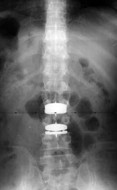 7, nörolojik yaralanma %2.8, implant yetersizliği %7.3 oranında görülmüştür. [11-13] Yamashita ve ark.