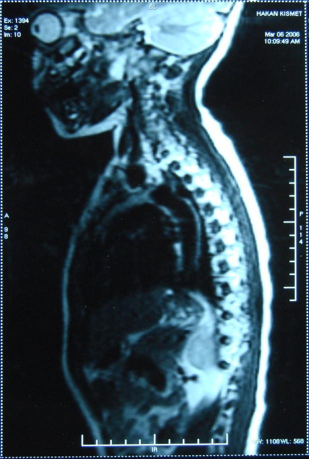 İlerleyen günlerde ve sağ bacakta uyuşukluk, güçsüzlük gelişmesi üzerine beyin cerrahisi ile konsülte edilerek spinal MR çekilmiş ve L4-S5 arasında yaklaşık 10 cm uzunluğunda ve sol L5-S1 ve sakral
